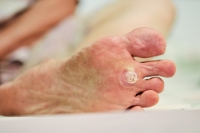 Treatment Options for Plantar Warts