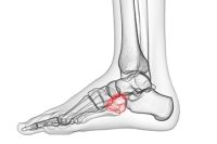 Causes and Prevalence of Cuboid Syndrome