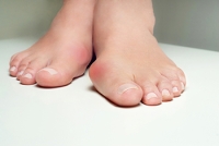 Exercises for Bunion Relief